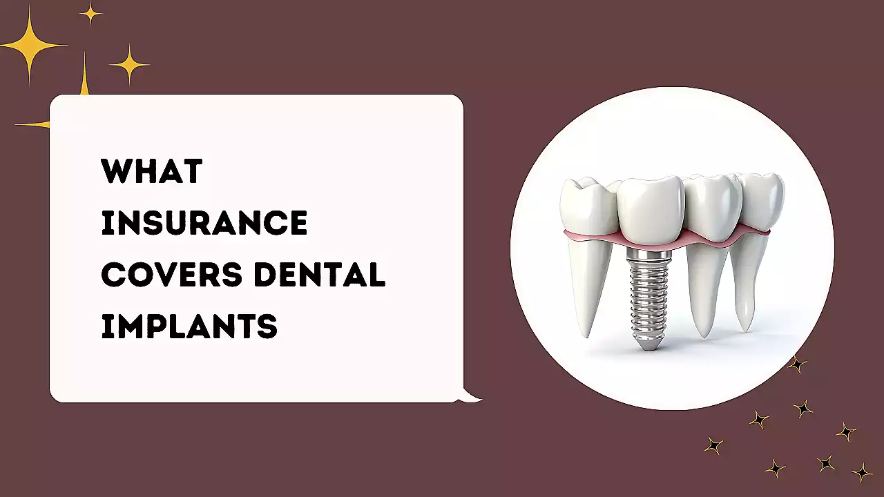 What Insurance Covers Dental Implants