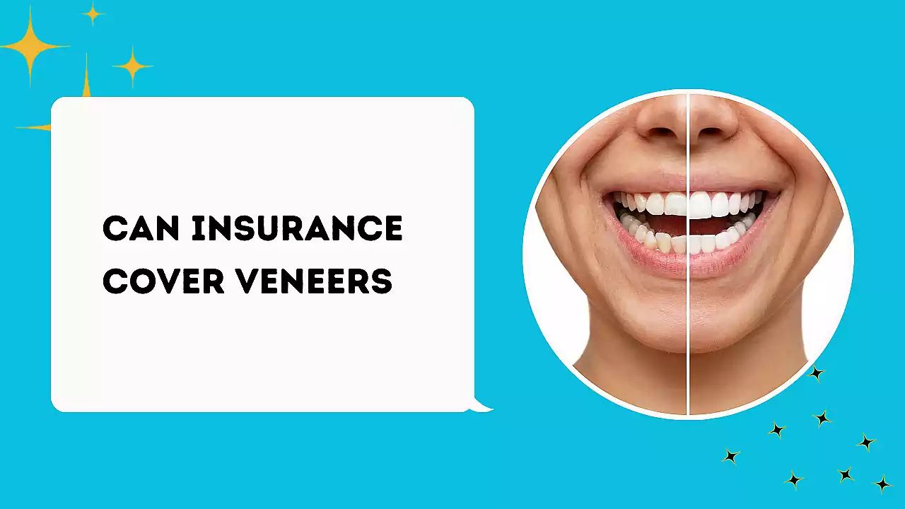 Can Insurance Cover Veneers